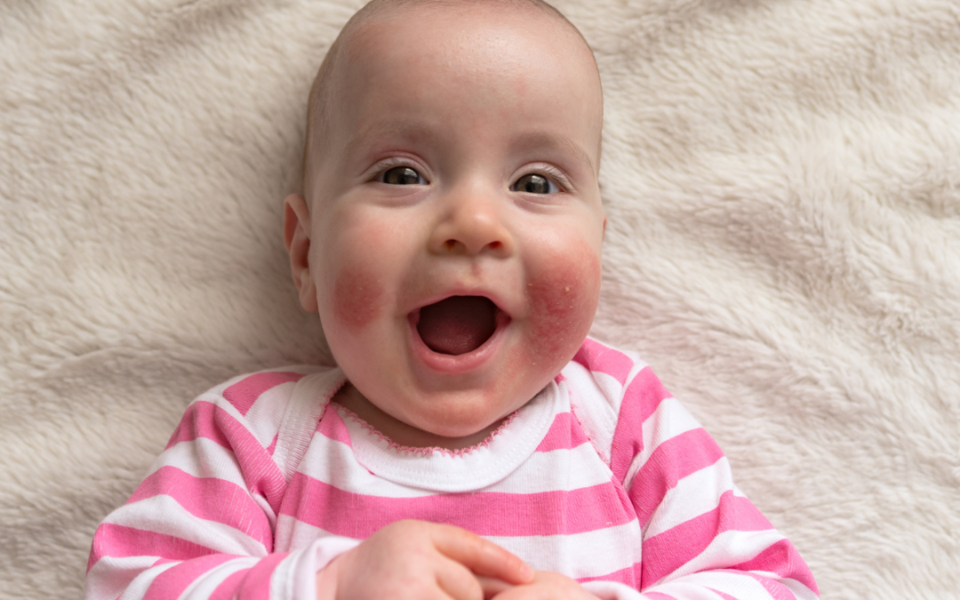 Neurodermitis bei Babys und Kindern vorbeugen