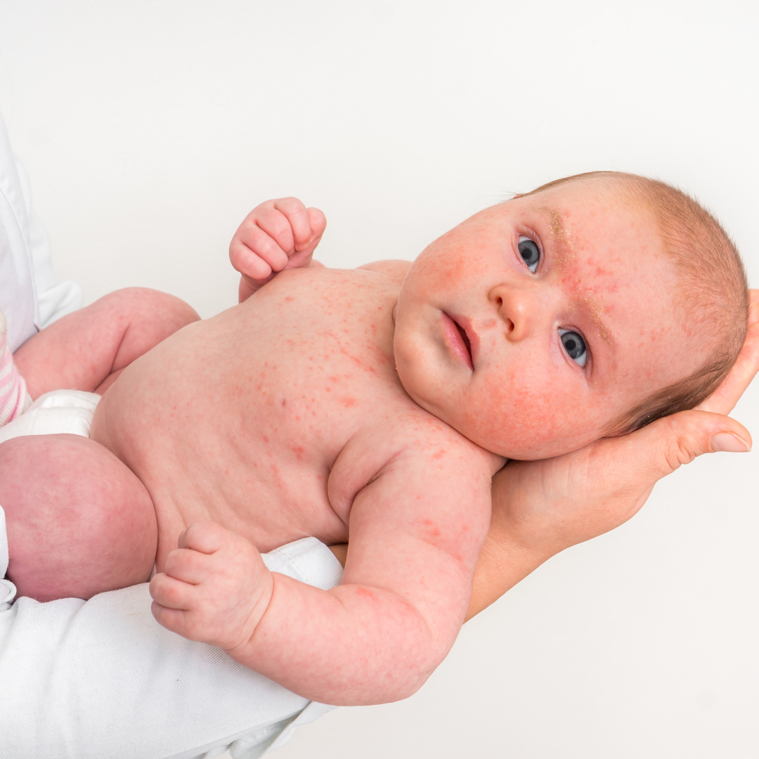 Ein kleines Baby mit rotem Ausschlag auf dem Körper und im Gesicht im Arm eines Arztes, der aufschaut 