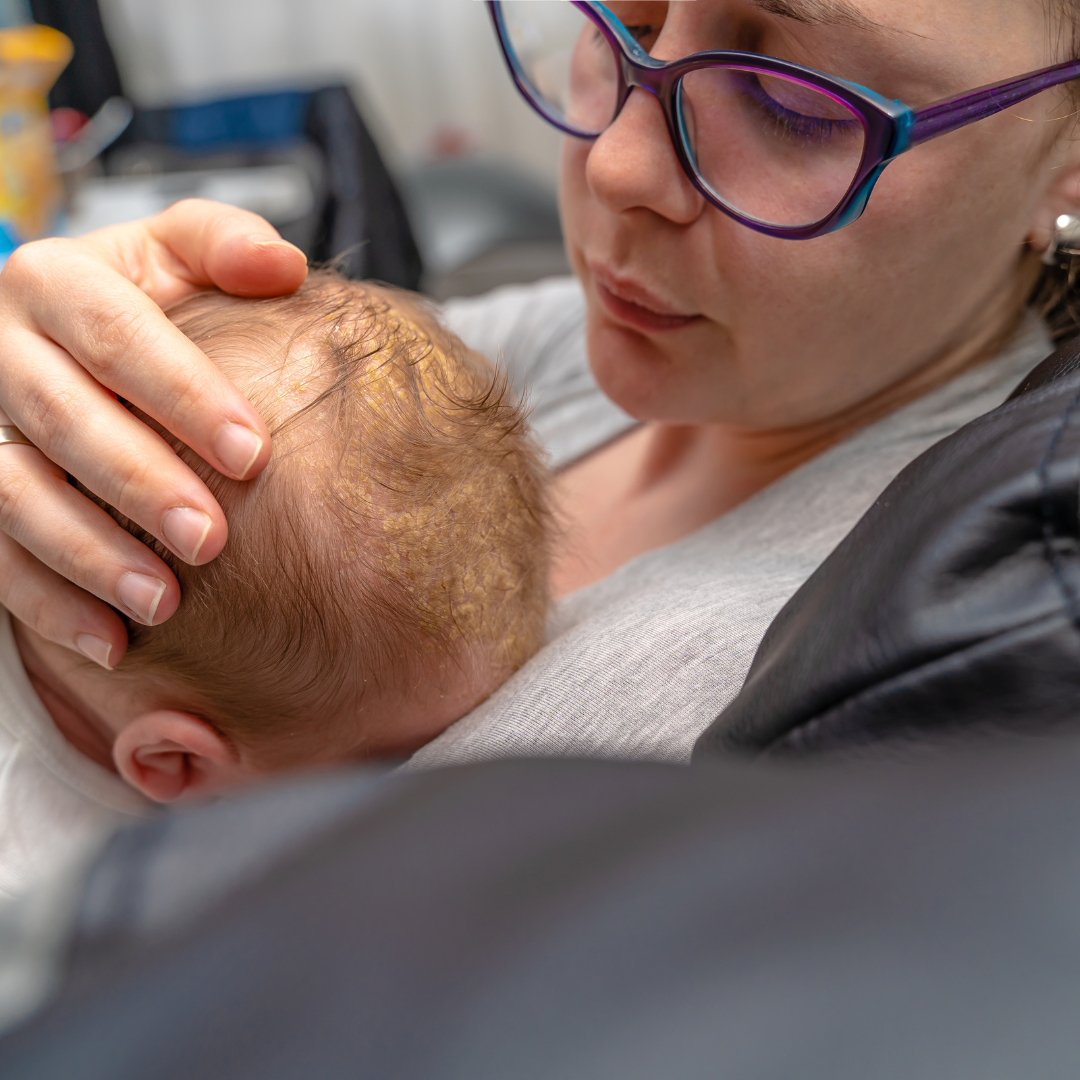 milchschorf mother cradling baby`s head